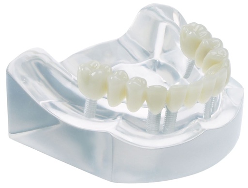 [SAMODC4] MODEL 6 IMPLANT BRIDGE