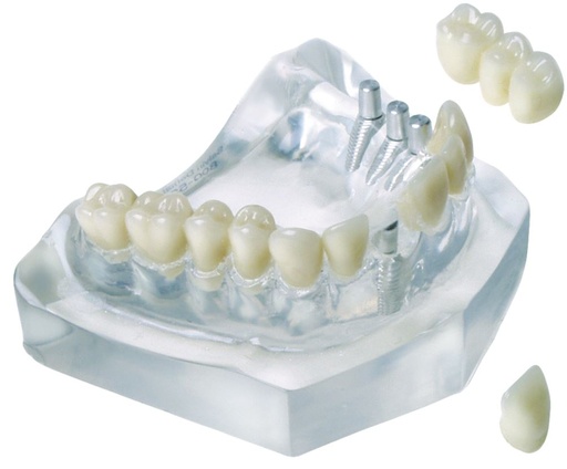 [SAMODC5] MODEL 3 IMPLANT BRIDGE & SINGLE TOOTH