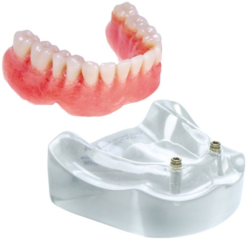 [SAMODLOC2] MODEL 2 IMPLANT LOCATOR LOWER OVERDENTURE