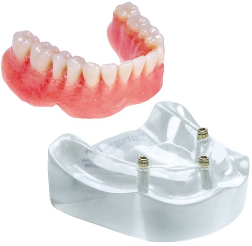 [SAMODLOC3] MODEL 3 IMPLANT LOCATOR LOWER OVERDENTURE